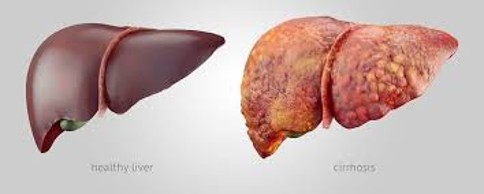 Illustration of a healthy liver and a liver with cirrosis